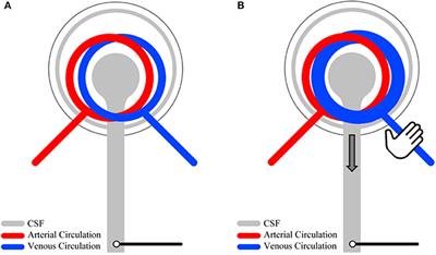 Cerebrospinal fluid pressure dynamics reveal signs of effective spinal canal narrowing in ambiguous spine conditions